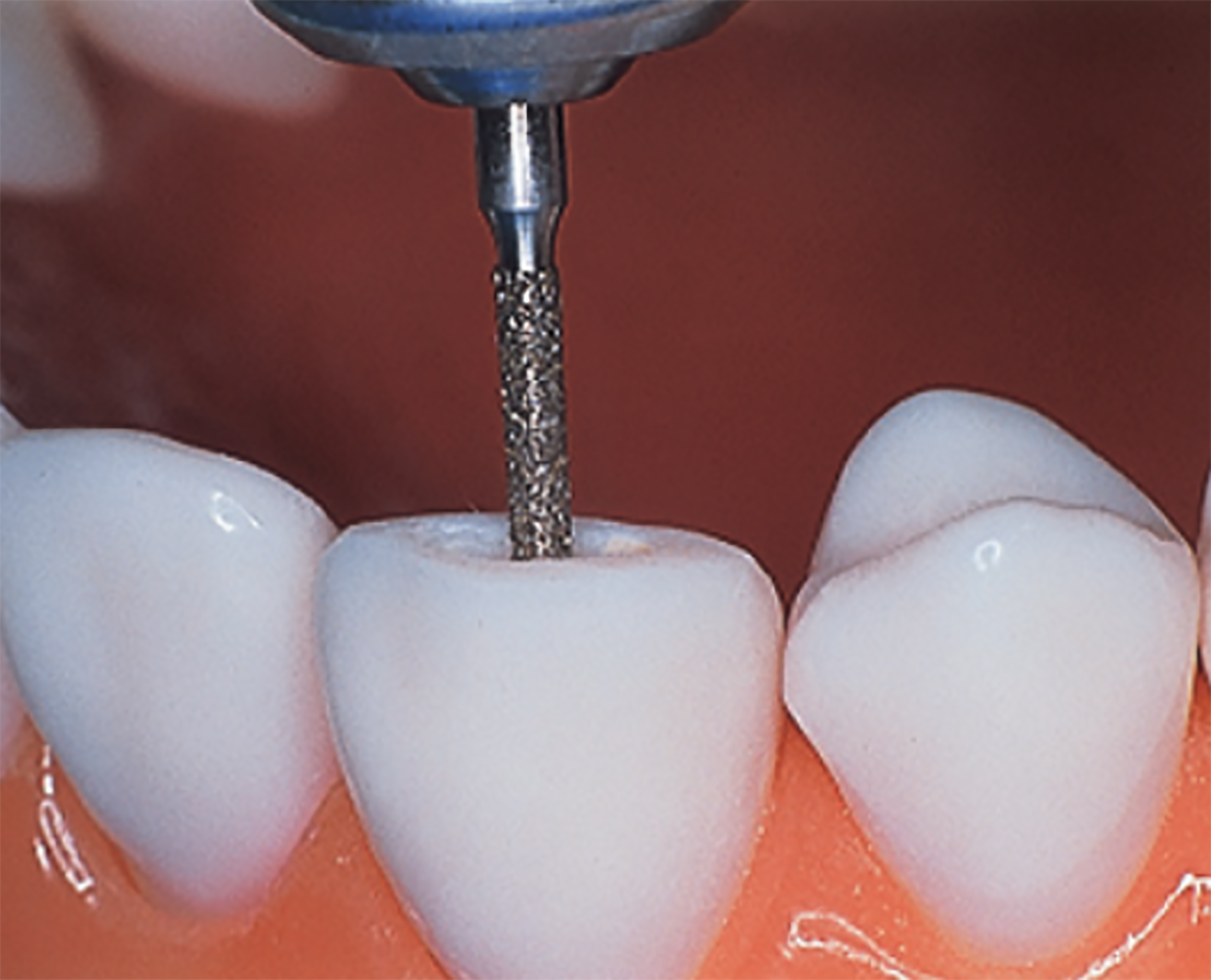 837 - Image of bur on teeth - Edenta South Africa - Confi-dent Clinical