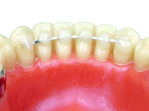 Flat Woven Wire for Retainer