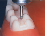 830 L - Diamond but on teeth - edenta south africa - Confident clinical