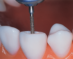 837 - Image of bur on teeth - Edenta South Africa - Confi-dent Clinical